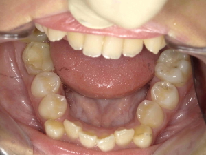 矯正治療例1（治療前２）