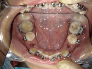 矯正治療例1（治療中２）